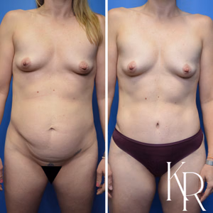 Tummy tuck before and after photo, front view