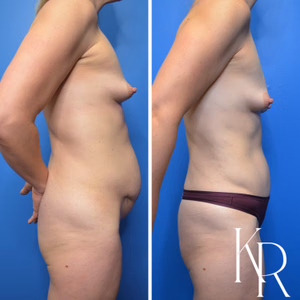 Tummy tuck before and after photo, side view