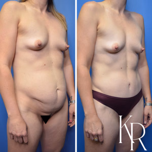 Tummy tuck before and after photo, side view