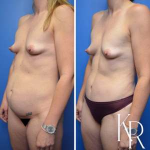 Tummy tuck before and after photo, oblique view