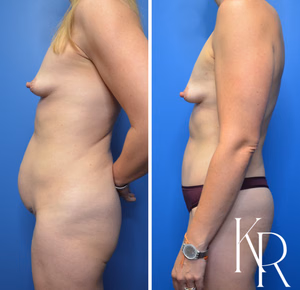 Tummy tuck before and after photo, side view