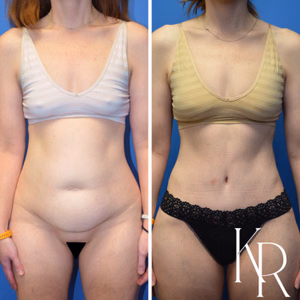 Tummy tuck before and after photo, front view