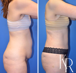 Tummy tuck before and after photo, side view