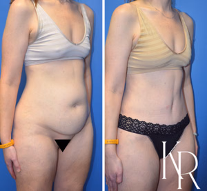 Tummy tuck before and after photo, side view