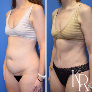 Tummy tuck before and after photo, oblique view