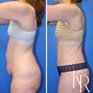 Tummy tuck before and after photo, side view