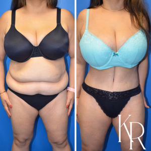 Tummy tuck before and after photo, front view