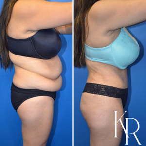 Tummy tuck before and after photo, side view