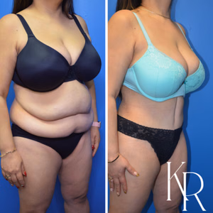 Tummy tuck before and after photo, front view