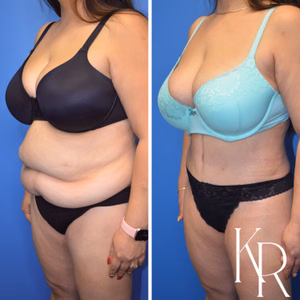 Tummy tuck before and after photo, oblique view
