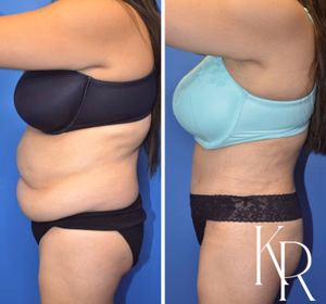 Tummy tuck before and after photo, side view