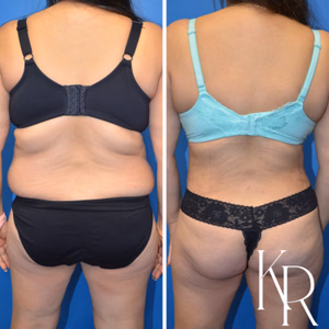 Tummy tuck before and after photo, rear view