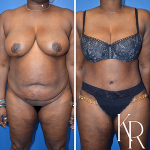 Tummy tuck before and after photo, front view