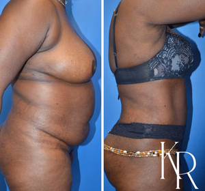 Tummy tuck before and after photo, side view
