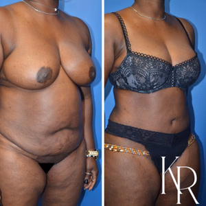 Tummy tuck before and after photo, side view