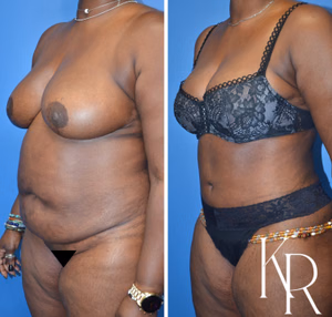 Tummy tuck before and after photo, oblique view
