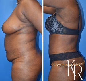 Tummy tuck before and after photo, front view