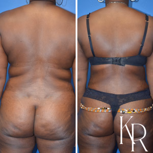 Tummy tuck before and after photo, rear view