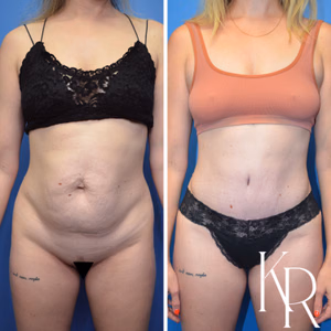 Tummy tuck before and after photo, front view