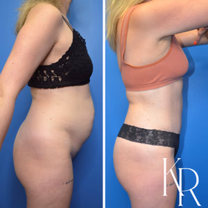 Tummy tuck before and after photo, side view