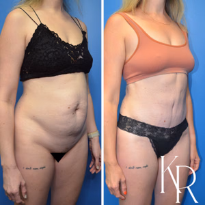 Tummy tuck before and after photo, front view