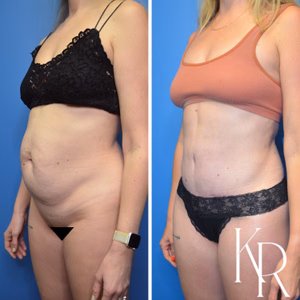 Tummy tuck before and after photo, oblique view