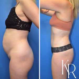Tummy tuck before and after photo, side view