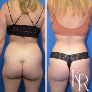 Tummy tuck before and after photo, rear view