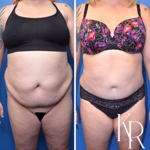 Tummy tuck before and after photo, front view