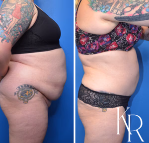 Tummy tuck before and after photo, side view