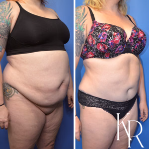 Tummy tuck before and after photo, side view