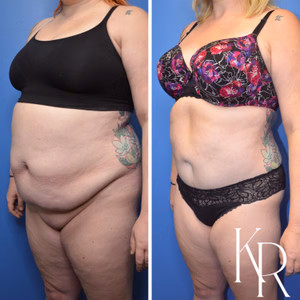 Tummy tuck before and after photo, oblique view