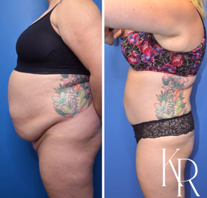 Tummy tuck before and after photo, side view