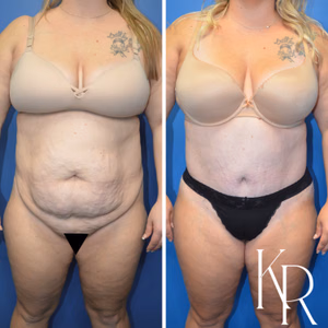 Tummy tuck before and after photo, front view