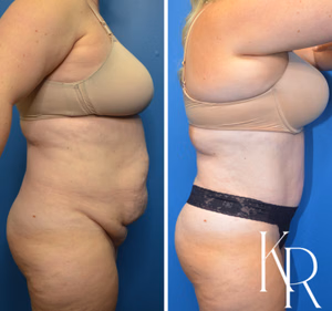 Tummy tuck before and after photo, side view