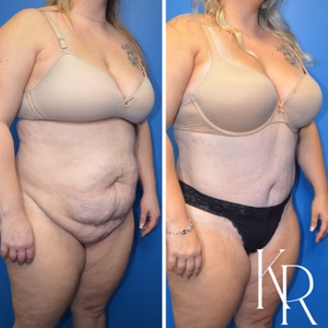 Tummy tuck before and after photo, front view