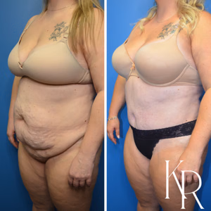 Tummy tuck before and after photo, oblique view