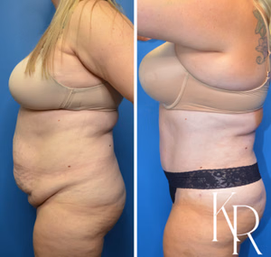 Tummy tuck before and after photo, rear view