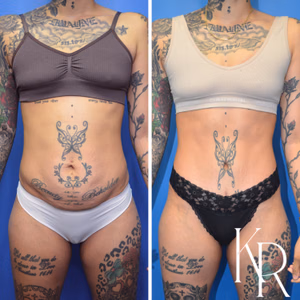 Tummy tuck before and after photo, front view
