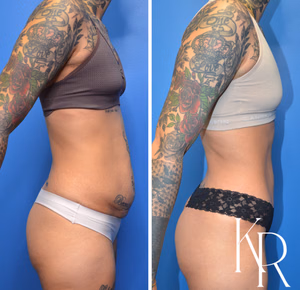 Tummy tuck before and after photo, side view