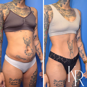 Tummy tuck before and after photo, oblique view