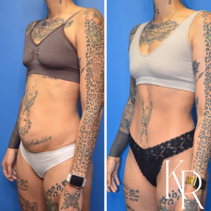 Tummy tuck before and after photo, oblique view