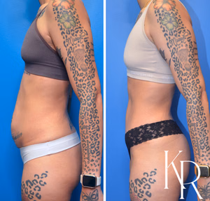 Tummy tuck before and after photo, side view