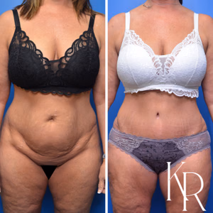 Tummy tuck before and after photo, front view