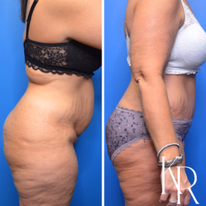 Tummy tuck before and after photo, side view