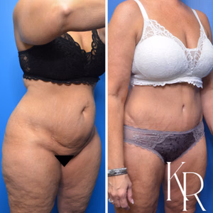 Tummy tuck before and after photo, oblique view