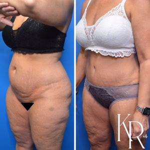 Tummy tuck before and after photo, side view