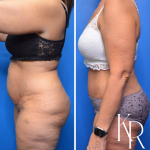 Tummy tuck before and after photo, rear view