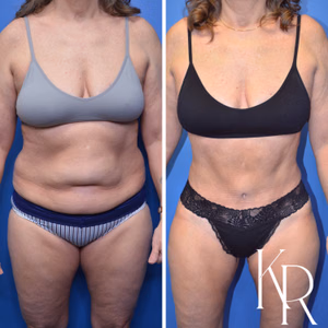 Tummy tuck before and after photo, front view