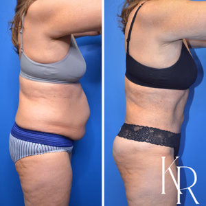 Tummy tuck before and after photo, side view